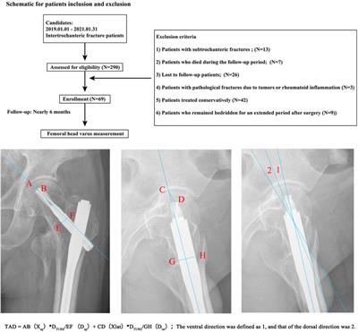 Impact of blade direction on postoperative femoral head varus in PFNA fixed patients: a clinical review and biomechanical research